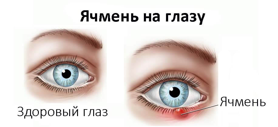 Альбуцид: при лечении ячменя